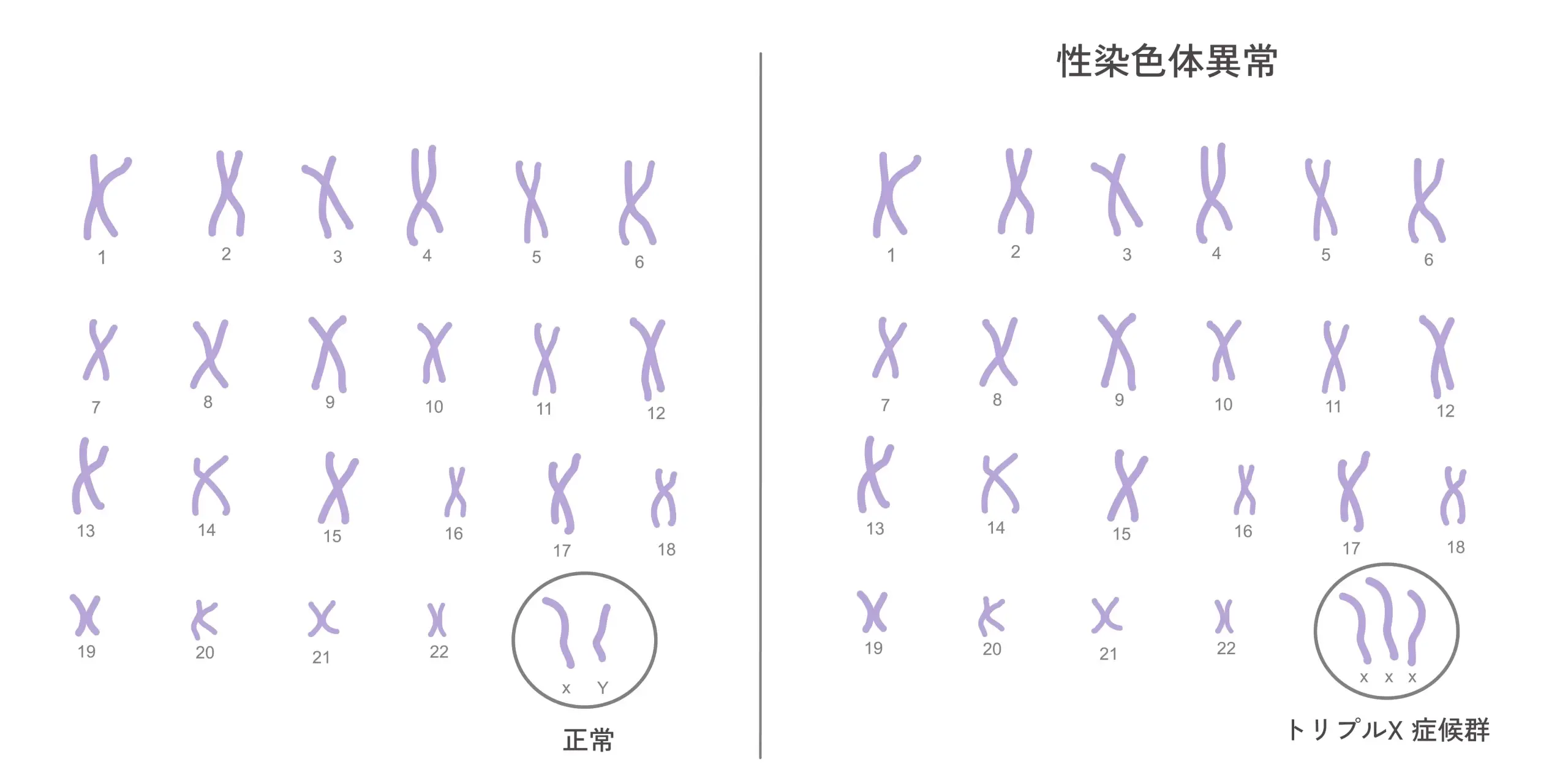Triple X Syndrome